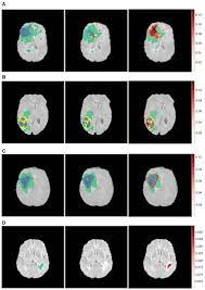 Demystifying brain tumor segmentation networks: interpretability and uncertainty analysis